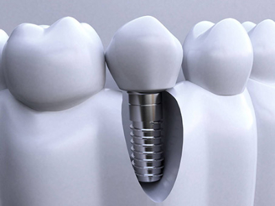 承德種植牙價格表，2024種植牙多少錢一顆呢?