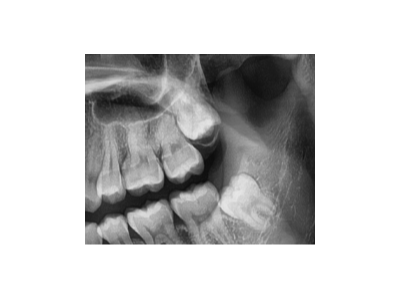 既然「智齒」不宜久留，為什么不能一次性拔掉？