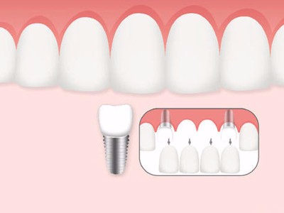 惟德口腔口腔種植怎么樣？惟德口腔就來為您一一解答